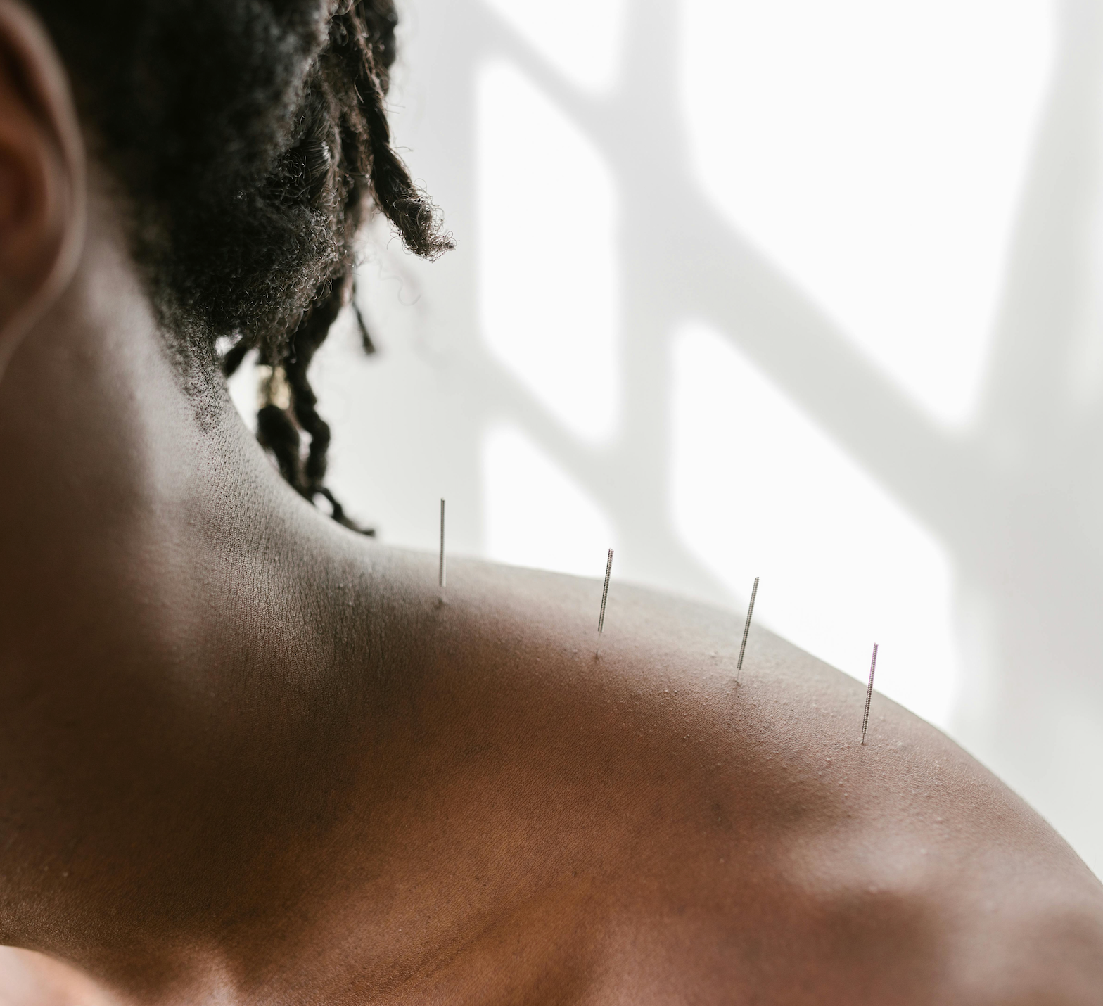 The Power of the Pin: Why I Turned to Acupuncture on My Healing Journey